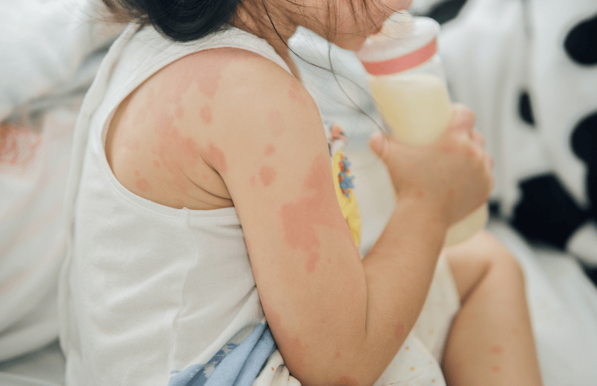 Water Softener and Eczema: Does It Help?